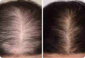 Louise K. before after