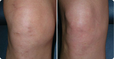 Anna B. before after