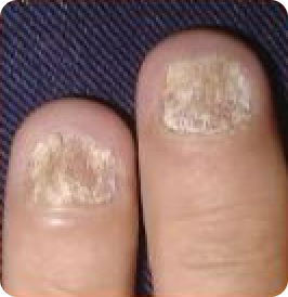 Psoriasis