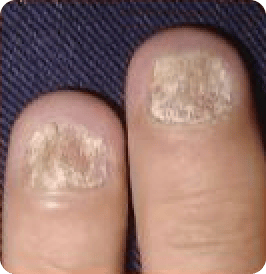 Psoriasis