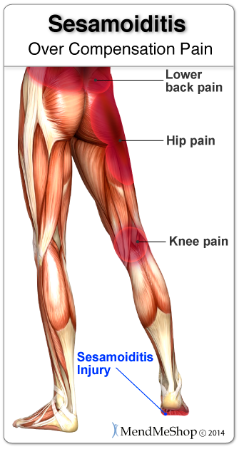 Long-term limping or shuffling with a sesamoiditis injury may lead to Overcompensation pain in the knee, hip and/or lower back.