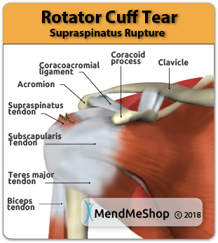 rotator-cuff-tear-rupture