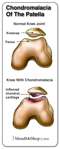 Chondromalacia patella treatment deals