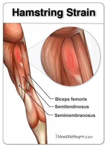 Hamstring strain or sprain, which is affected 