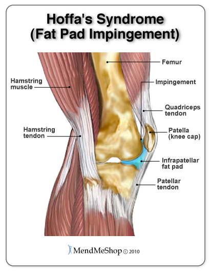 Hoffa's Syndrome (fat pad impingement) causes pinch pain in the front of the knee with swelling and inflammation under the knee cap (patella) and along the patellar tendon.