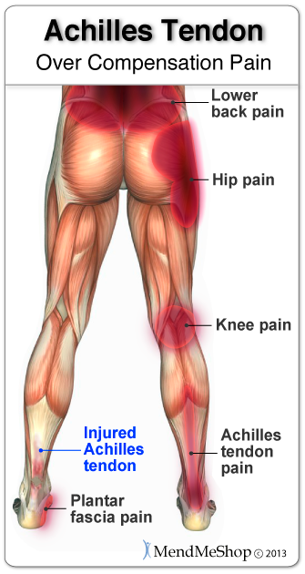 Over compensation pain can result in a severe setback Achilles tendonitis