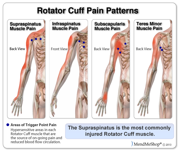 Rotator cuff pain patterns & trigger points - hypersensitive areas in the muscle - sources of on-going pain.