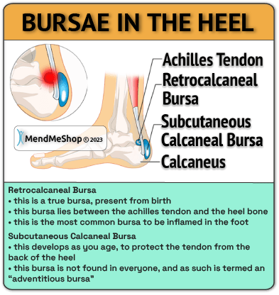 bursas in the heel can be treated naturally conservative home treatments