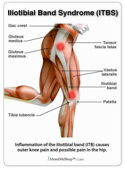 Iliotibial band syndrome causes pain at knee & hip side