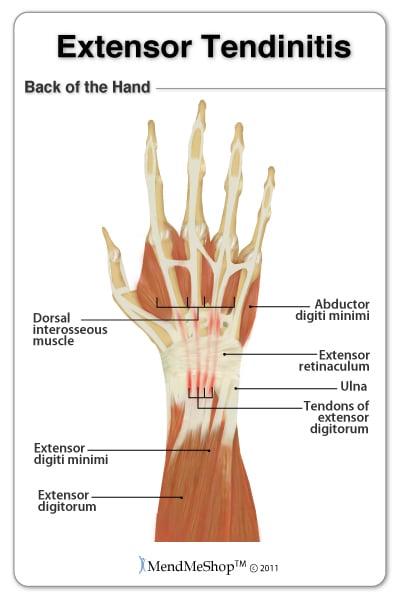Tendinitis in the wrist