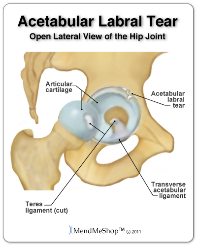 An acetabular labral tear in the hip.