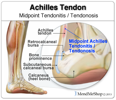 Midpoint Insertional Achilles Tendonitis Tendonosis