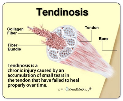 Tendinosis pain and tissue degeneration.