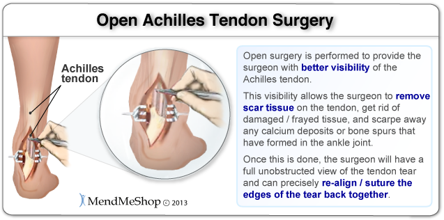 Open surgery is performed to provide the surgeon with better visibility of the Achilles tendon. This visibility allows the surgeon to remove scar tissue on the tendon, damaged/frayed tissue and any calcium deposits or bone spurs that have formed in the ankle joint. Once this is done, the surgeon will have a full unobstructed view of the tendon tear and can precisely re-align/suture the edges of the tear back together.