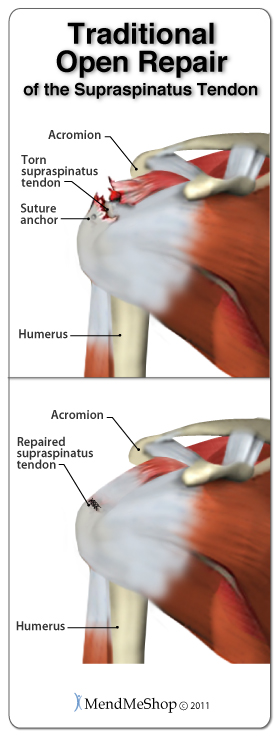 Supraspinatus rotator cuff tear surgery recovery.