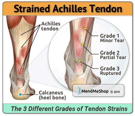 Achilles Tendon strain or sprain, which is affecting 