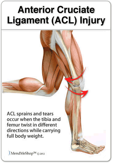 Cause of ACL sprain or ACL tear