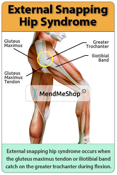 External snapping hip syndrome occurs when the IT band or gluteus maximus tendon catch on the greater trochanter.
