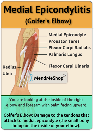 Information About Medial Epicondylitis, aka. Golfers Elbow