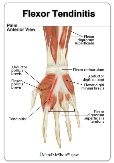 Extensor Tendonitis in the hand