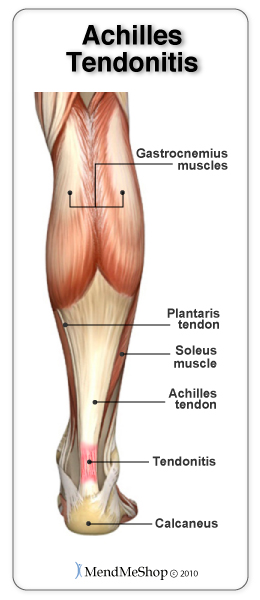 Chronic Achilles tendinitis can lead to tendinosis, tenosynovitis or a complete rupture if untreated