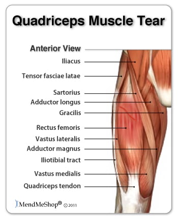 quadriceps & thigh muscle tear