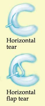 horizontal flap tear