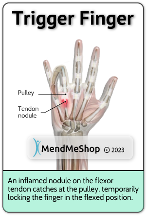inflamed flexor tendon nodule locks the finger in a flexed position