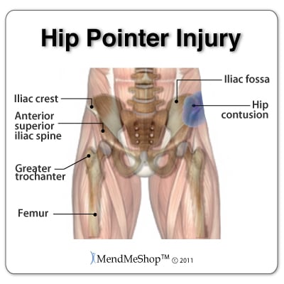Hip pointer injury left hip