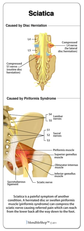sciatic nerve pinch cause disc herniation or piriformis syndrome