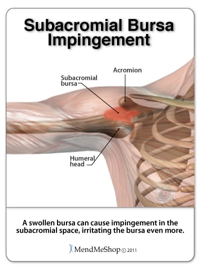 Rotator Cuff Injuries: Tears, Impingement, and Tendonitis