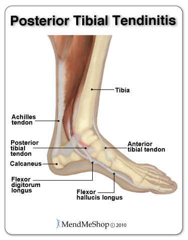 Posterior Tibial Tendinitis: Symptoms, Causes, Diagnosis & Treatments