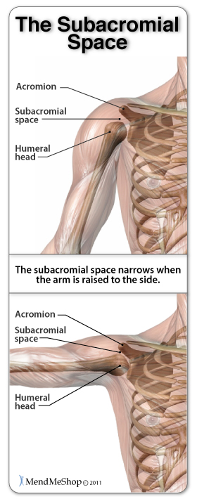 Shoulder Impingement Syndrome occurs when the subacromial space lessens due to misalignment, abnormal bone growths, thickening of the tendon, or swelling in the bursa.