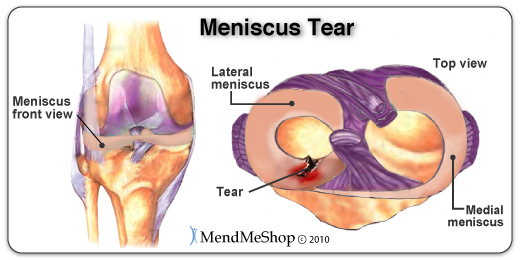 Degree & location of tear determines if surgery is necessary to suture the meniscus back together.