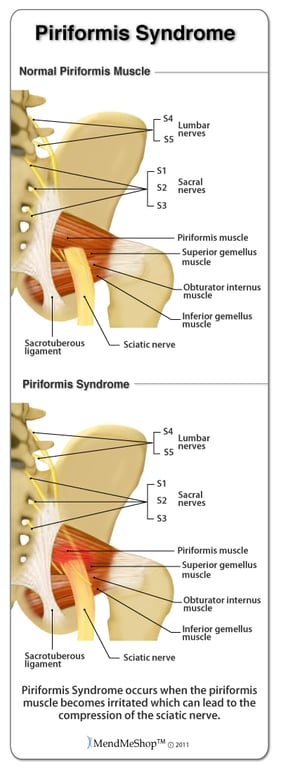 Piriformis Syndrome is inflammation in the piriformis muscle which causes irritation and compression of the sciatic nerve