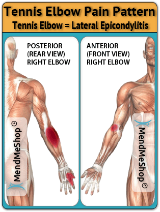 Forearm Muscle Strain
