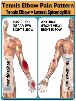 Tennis Elbow Pain Pattern