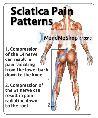 Sciatica Pain Pattern