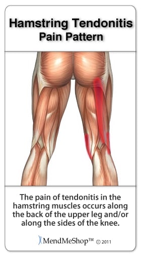 Hamstring Tendonitis pain patterns