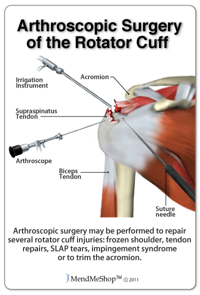 Concerns about rotator cuffs - why operate?