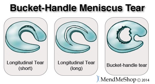 Medial Meniscus