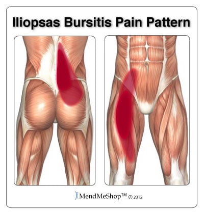 Pain Pattern Iliopsoas Bursitis