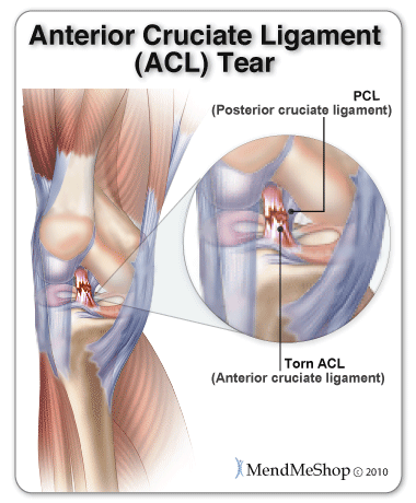 Anterior Cruciate Ligament (ACL) tears cause knee pain and instability