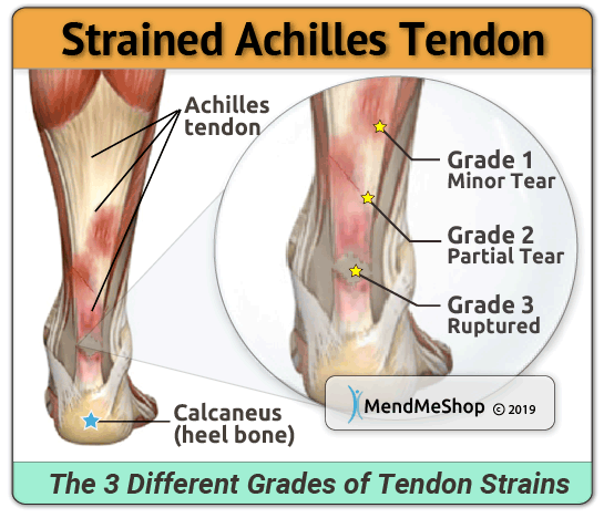 Achilles Tendon strain types