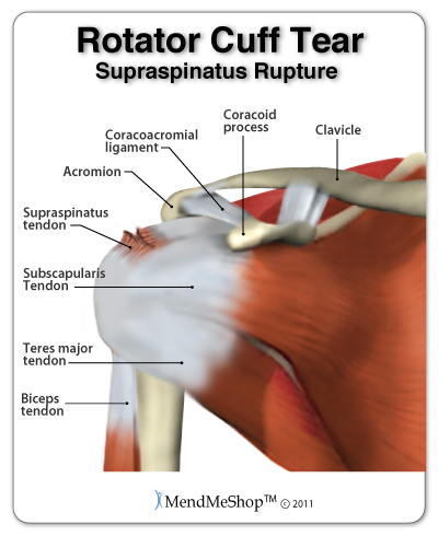 Torn rotator cuff clearance tendon