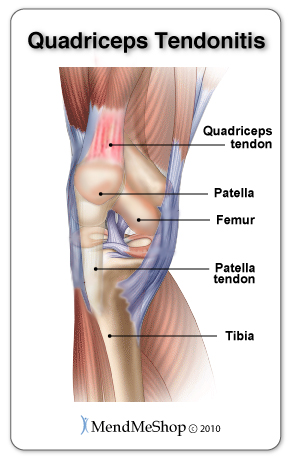 Quadriceps tendinitis - inflammation of the quadriceps tendon is caused by tiny tears that are not giving the proper rest to heal.