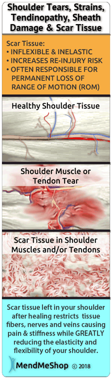 Rotator cuff surgery can heal with difficulties because of scar tissue