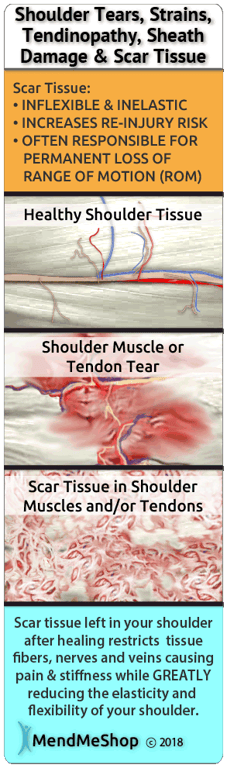 Rotator cuff surgery can heal with difficulties because of scar tissue