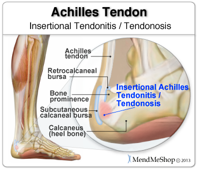 What You Need to Know About Achilles Tendonitis