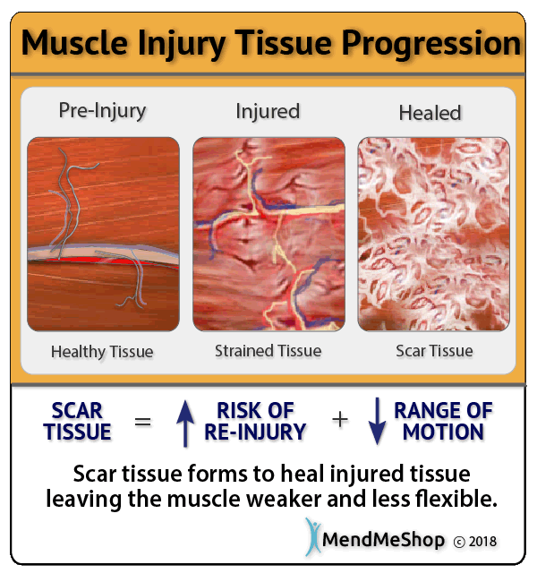 torn soft tissue heals with scar tissue, restricting movement and causing pain and stiffness